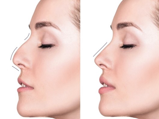 همه چیز درباره لیفت بینی با نخ