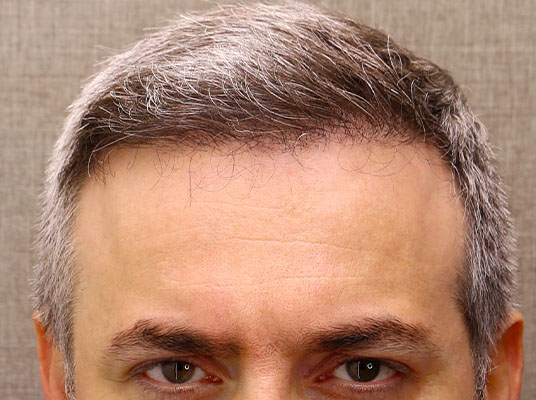 درمـان ریـزش مـو_after_web