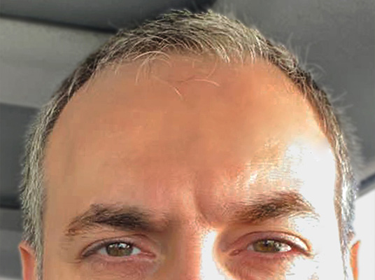 درمـان ریـزش مـو_before_web